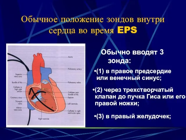 Обычное положение зондов внутри сердца во время EPS Обычно вводят 3 зонда: