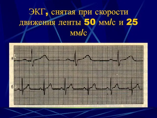 ЭКГ, снятая при скорости движения ленты 50 мм/с и 25 мм/с