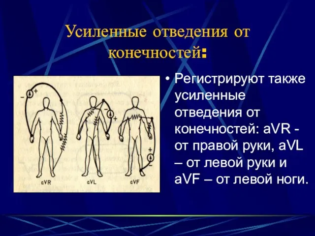 Усиленные отведения от конечностей: Регистрируют также усиленные отведения от конечностей: aVR -