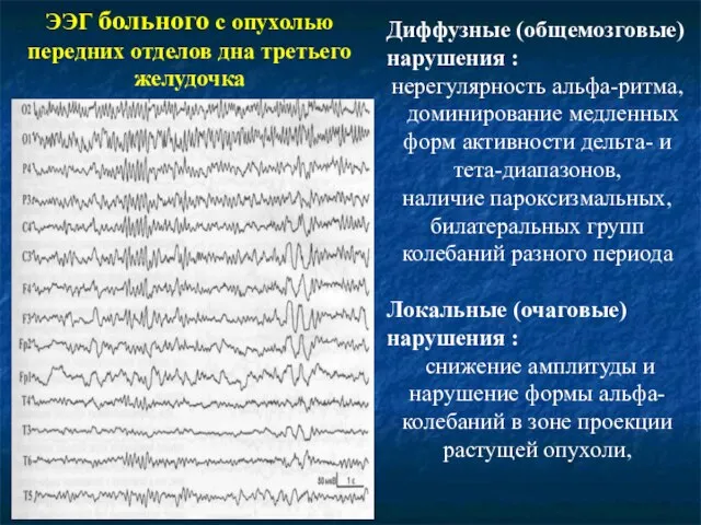 ЭЭГ больного с опухолью передних отделов дна третьего желудочка Диффузные (общемозговые) нарушения