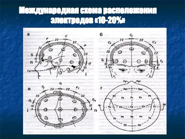 Международная схема расположения электродов «10-20%»