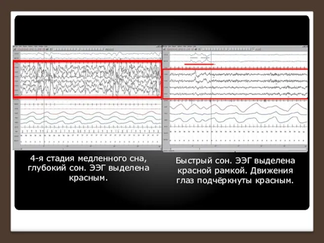 4-я стадия медленного сна, глубокий сон. ЭЭГ выделена красным. Быстрый сон. ЭЭГ