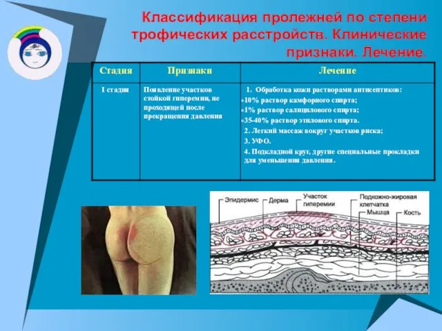 Классификация пролежней по степени трофических расстройств. Клинические признаки. Лечение.