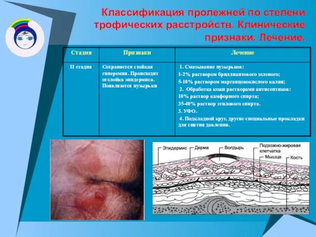 Классификация пролежней по степени трофических расстройств. Клинические признаки. Лечение.