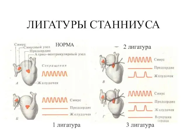 ЛИГАТУРЫ СТАННИУСА НОРМА 1 лигатура 2 лигатура 3 лигатура