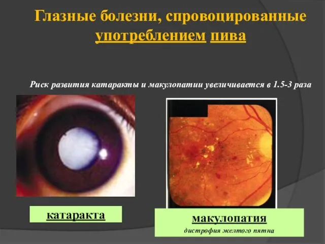 Глазные болезни, спровоцированные употреблением пива Риск развития катаракты и макулопатии увеличивается в