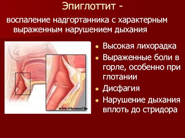 Эпиглоттит - воспаление надгортанника с характерным выраженным нарушением дыхания Высокая лихорадка Выраженные
