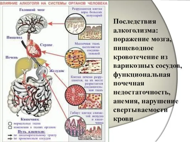 Последствия алкоголизма: поражение мозга, пищеводное кровотечение из варикозных сосудов, функциональная почечная недостаточность, анемия, нарушение свертываемости крови