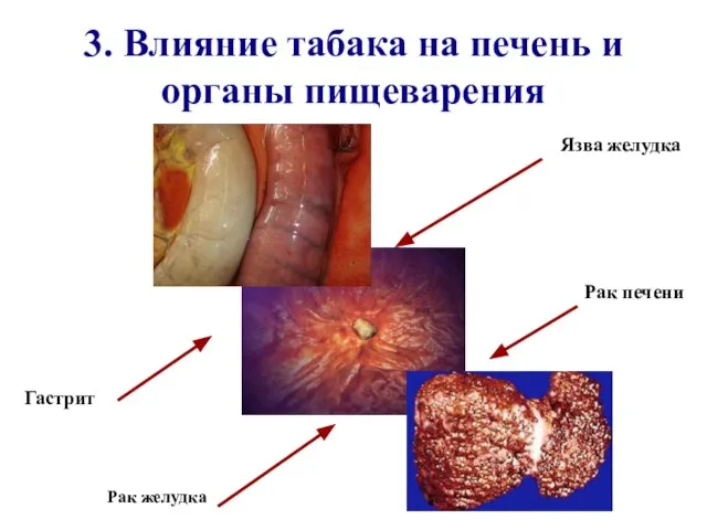 3. Влияние табака на печень и органы пищеварения Рак желудка Гастрит Рак печени Язва желудка