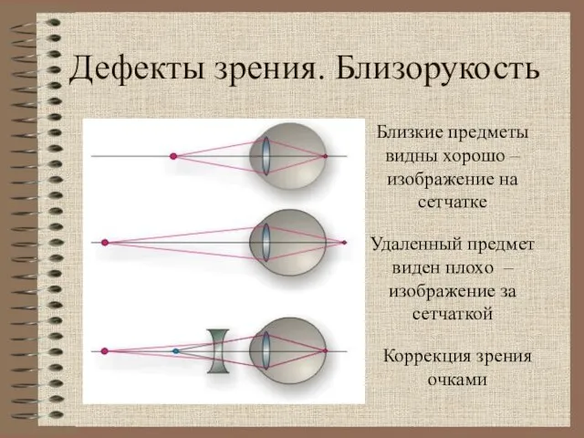 Дефекты зрения. Близорукость Близкие предметы видны хорошо – изображение на сетчатке Удаленный