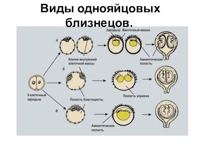 Виды однояйцовых близнецов.