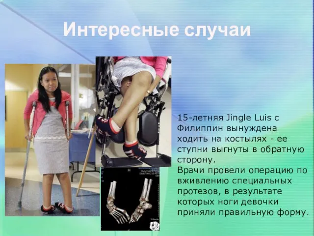 Интересные случаи 15-летняя Jingle Luis с Филиппин вынуждена ходить на костылях -