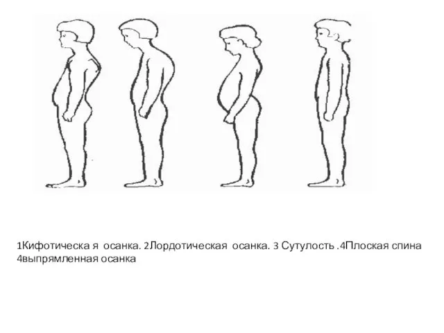 1Кифотическа я осанка. 2Лордотическая осанка. 3 Сутулость .4Плоская спина 4выпрямленная осанка