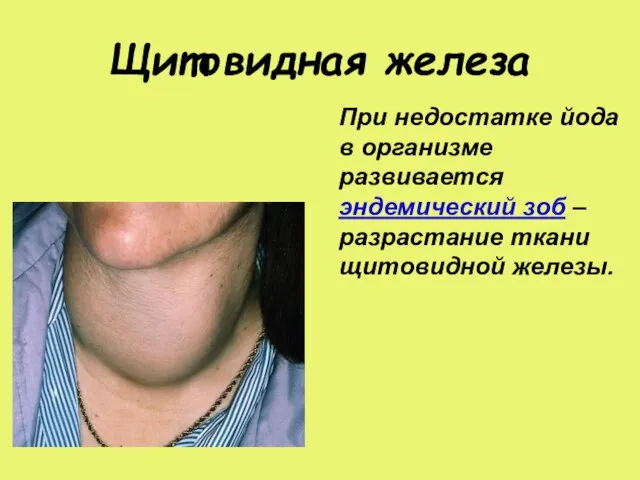 Щитовидная железа При недостатке йода в организме развивается эндемический зоб – разрастание ткани щитовидной железы.