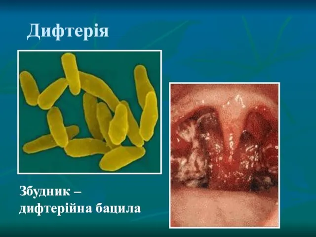 Дифтерія Збудник – дифтерійна бацила