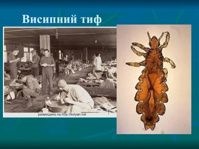 Висипний тиф