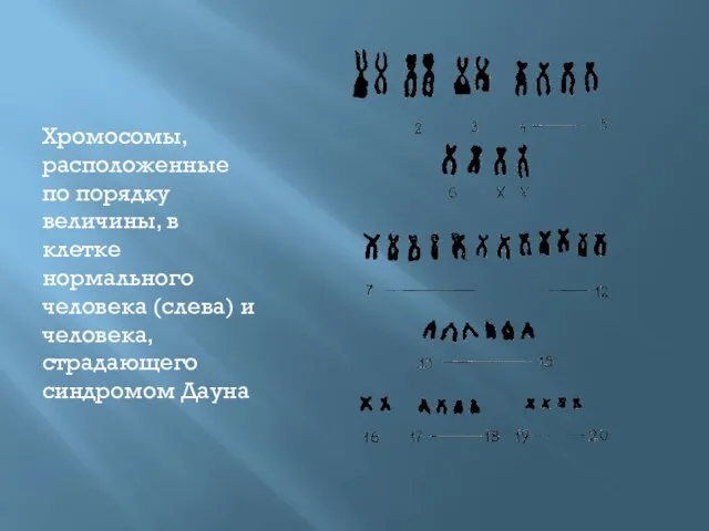 Хромосомы, расположенные по порядку величины, в клетке нормального человека (слева) и человека, страдающего синдромом Дауна