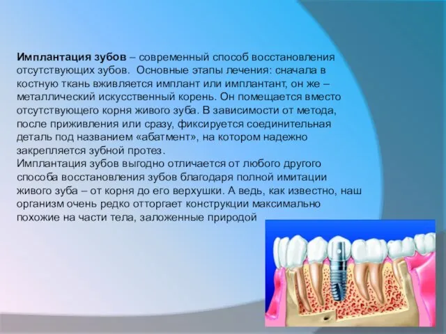 Имплантация зубов – современный способ восстановления отсутствующих зубов. Основные этапы лечения: сначала