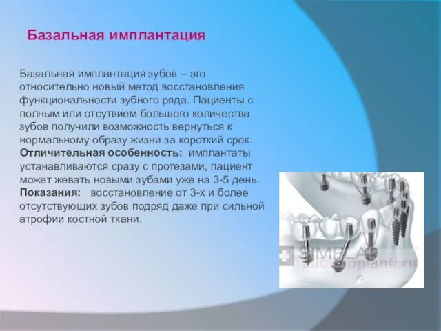 Базальная имплантация Базальная имплантация зубов – это относительно новый метод восстановления функциональности