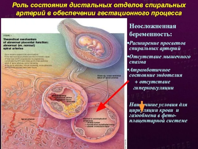 Роль состояния дистальных отделов спиральных артерий в обеспечении гестационного процесса Неосложненная беременность: