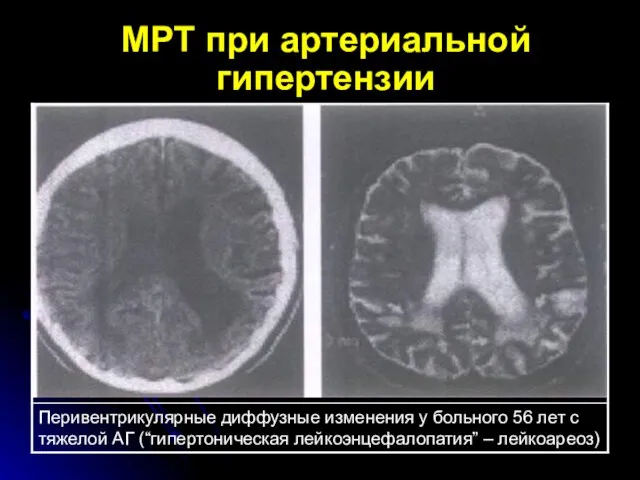 МРТ при артериальной гипертензии