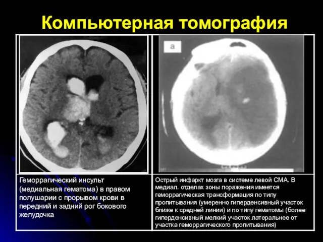 Компьютерная томография