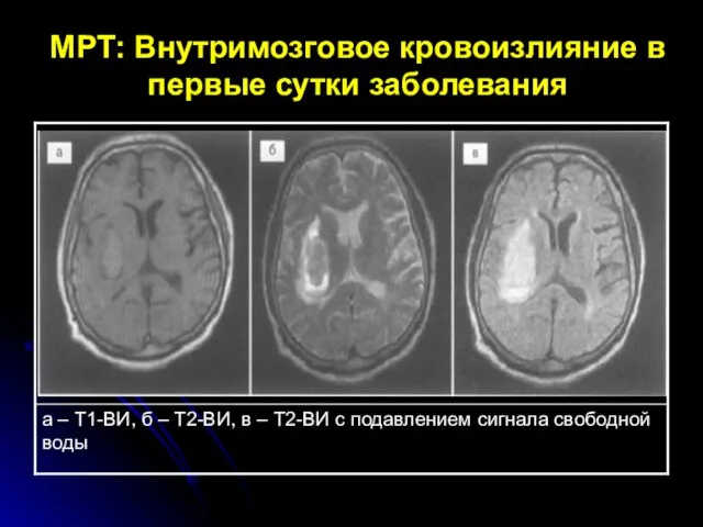 МРТ: Внутримозговое кровоизлияние в первые сутки заболевания