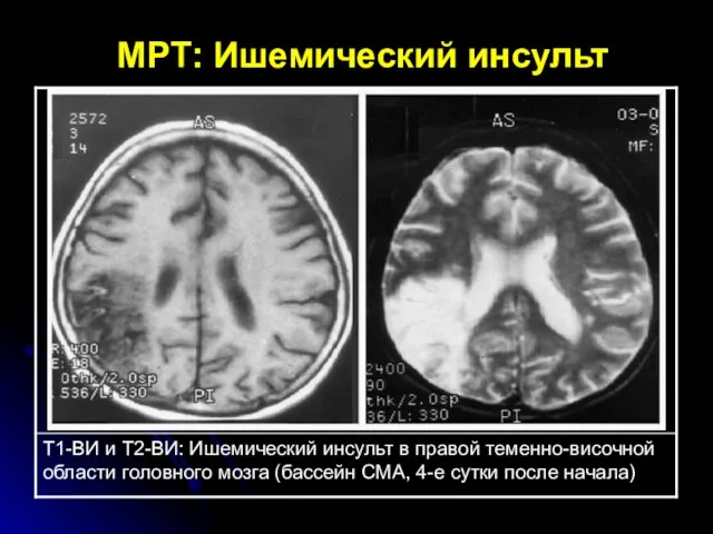 МРТ: Ишемический инсульт