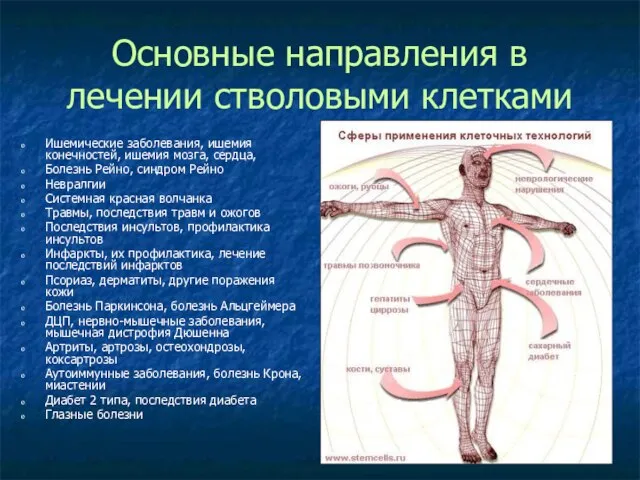 Основные направления в лечении стволовыми клетками Ишемические заболевания, ишемия конечностей, ишемия мозга,