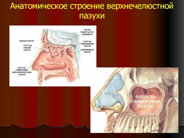 Анатомическое строение верхнечелюстной пазухи