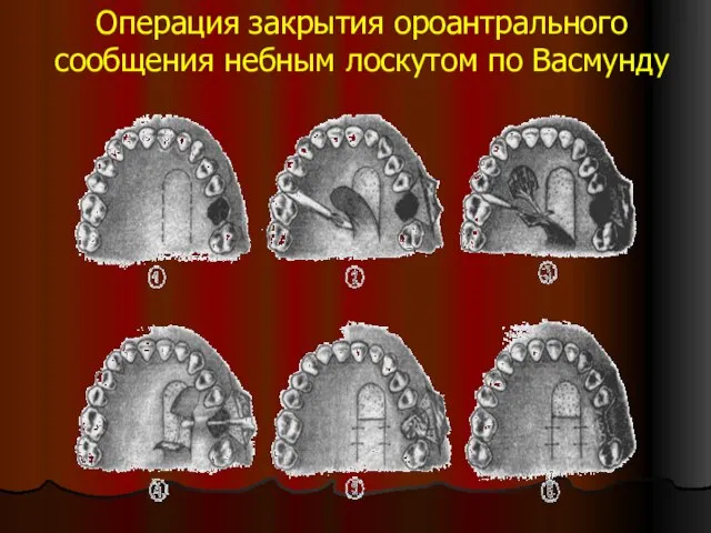 Операция закрытия ороантрального сообщения небным лоскутом по Васмунду