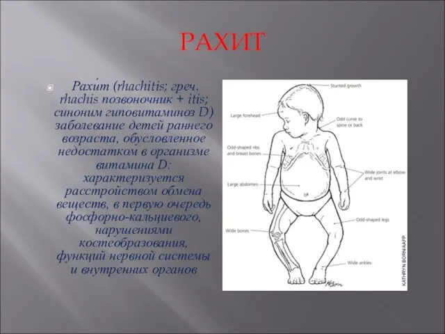 РАХИТ Рахи́т (rhachitis; греч. rhachis позвоночник + itis; синоним гиповитаминоз D) заболевание