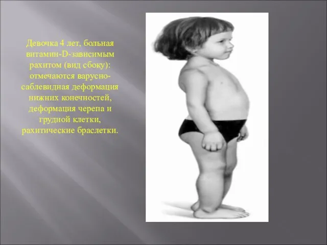Девочка 4 лет, больная витамин-D-зависимым рахитом (вид сбоку): отмечаются варусно-саблевидная деформация нижних