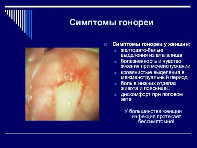 Симптомы гонореи Симптомы гонореи у женщин: желтовато-белые выделения из влагалища болезненность и