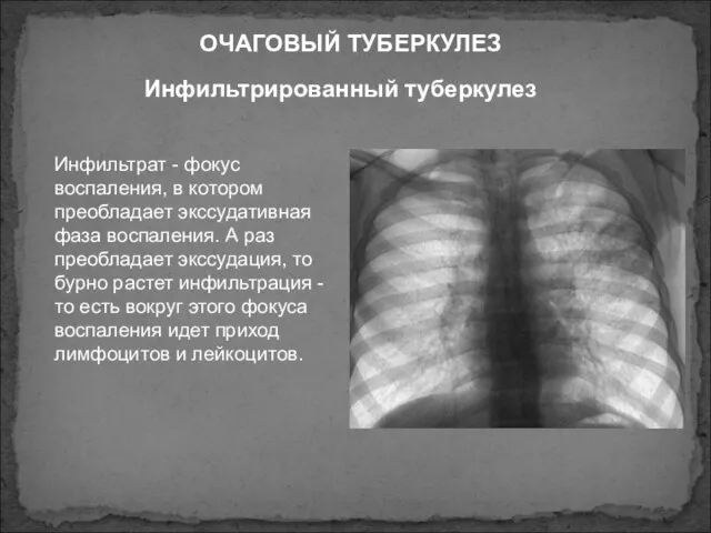 Инфильтрированный туберкулез ОЧАГОВЫЙ ТУБЕРКУЛЕЗ Инфильтрат - фокус воспаления, в котором преобладает экссудативная