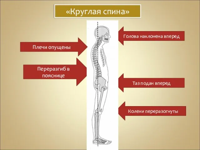 «Круглая спина» Голова наклонена вперед Таз подан вперед Колени переразогнуты Переразгиб в пояснице Плечи опущены