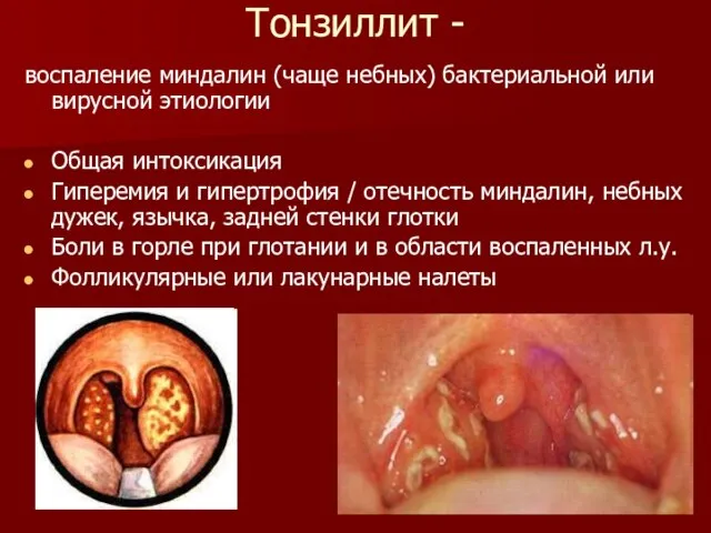 Тонзиллит - воспаление миндалин (чаще небных) бактериальной или вирусной этиологии Общая интоксикация