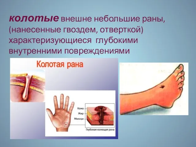 колотые внешне небольшие раны, (нанесенные гвоздем, отверткой) характеризующиеся глубокими внутренними повреждениями