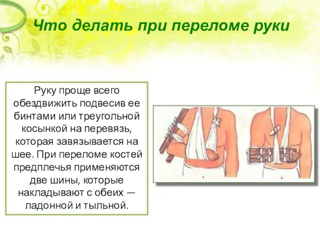 Что делать при переломе руки Руку проще всего обездвижить подвесив ее бинтами