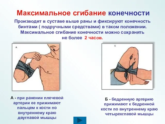 Максимальное сгибание конечности Производят в суставе выше раны и фиксируют конечность бинтами