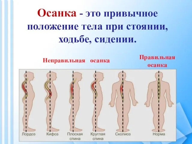 Осанка - это привычное положение тела при стоянии, ходьбе, сидении. Правильная осанка Неправильная осанка