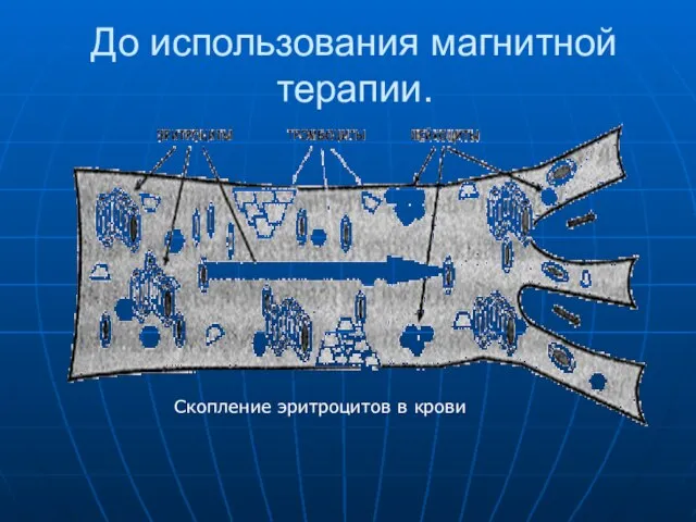 До использования магнитной терапии. Скопление эритроцитов в крови