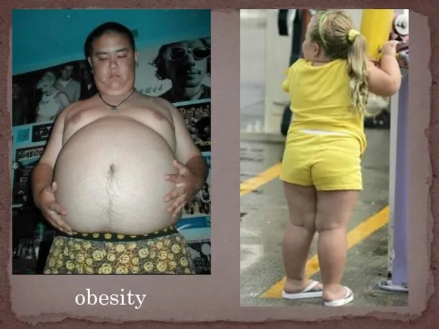 obesity