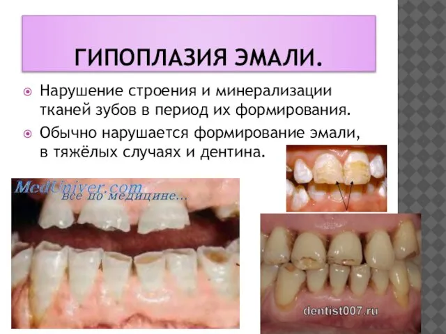 Гипоплазия эмали. Нарушение строения и минерализации тканей зубов в период их формирования.