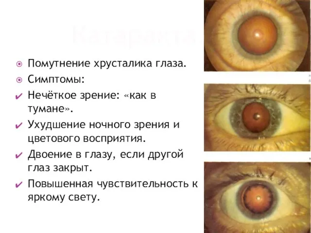 Катаракта. Помутнение хрусталика глаза. Симптомы: Нечёткое зрение: «как в тумане». Ухудшение ночного