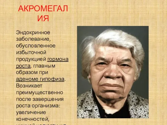 АКРОМЕГАЛИЯ Эндокринное заболевание, обусловленное избыточной продукцией гормона роста, главным образом при аденоме