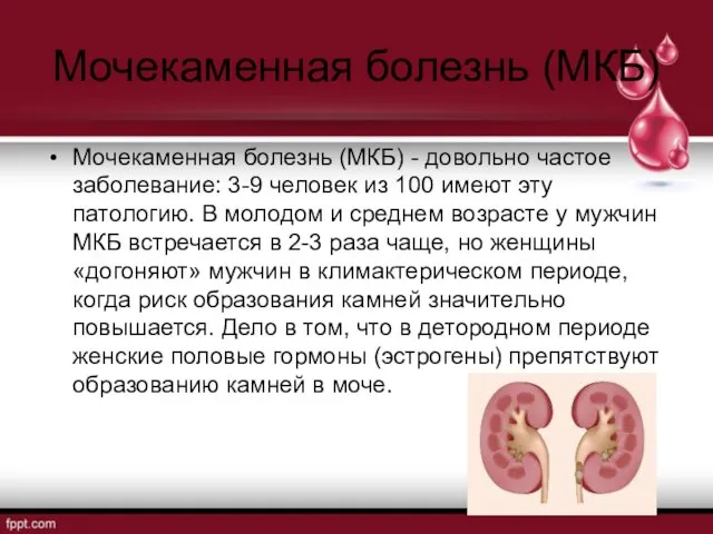 Мочекаменная болезнь (МКБ) Мочекаменная болезнь (МКБ) - довольно частое заболевание: 3-9 человек