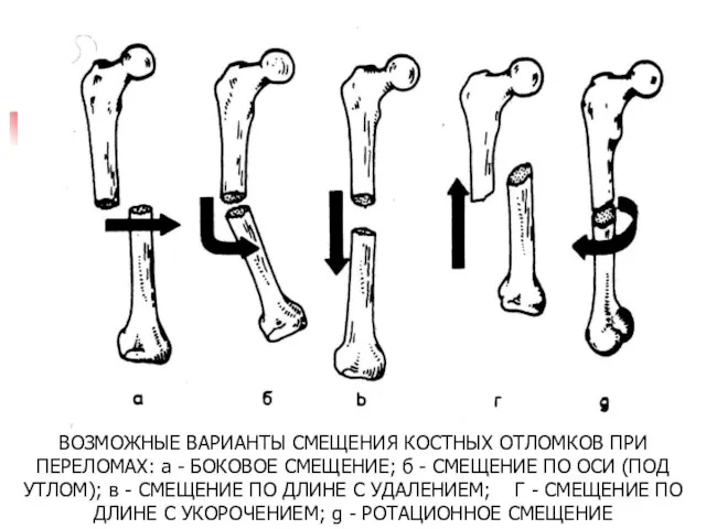 ВОЗМОЖНЫЕ ВАРИАНТЫ СМЕЩЕНИЯ КОСТНЫХ ОТЛОМКОВ ПРИ ПЕРЕЛОМАХ: а - БОКОВОЕ СМЕЩЕНИЕ; б