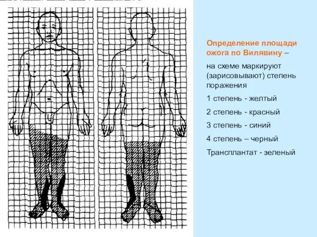 Определение площади ожога по Вилявину – на схеме маркируют(зарисовывают) степень поражения 1