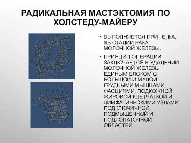 Радикальная мастэктомия по Холстеду-Майеру Выполняется при IIб, IIIа, IIIб стадии рака молочной